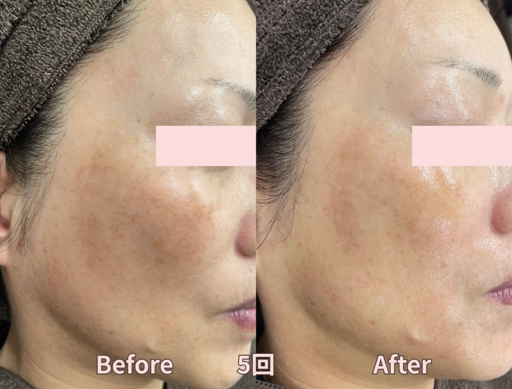 水光ピーリングで期待できる効果