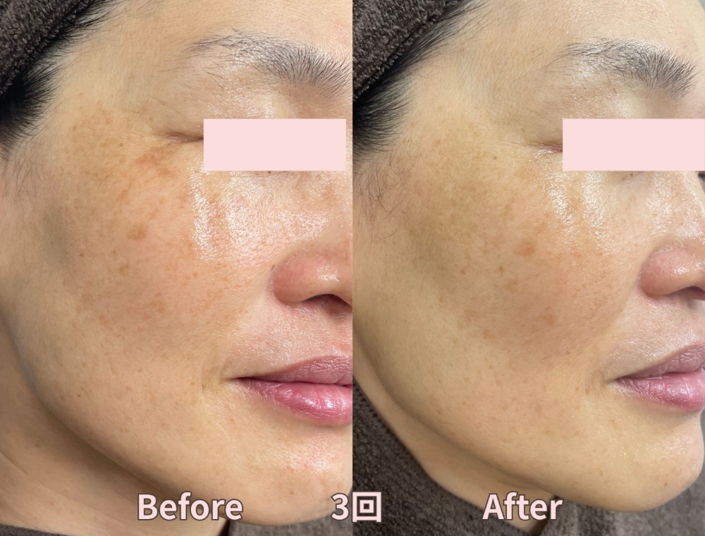 水光ピーリングで期待できる効果