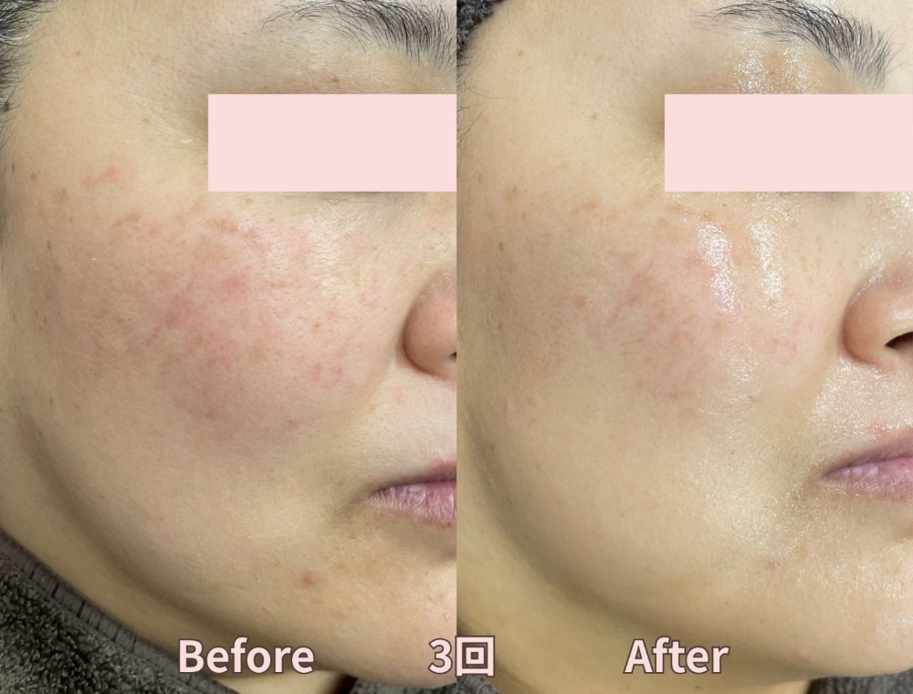 水光ピーリングで期待できる効果