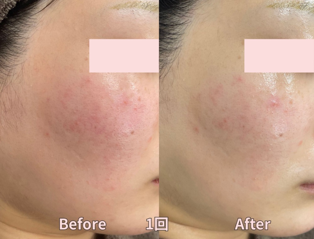 水光ピーリングで期待できる効果