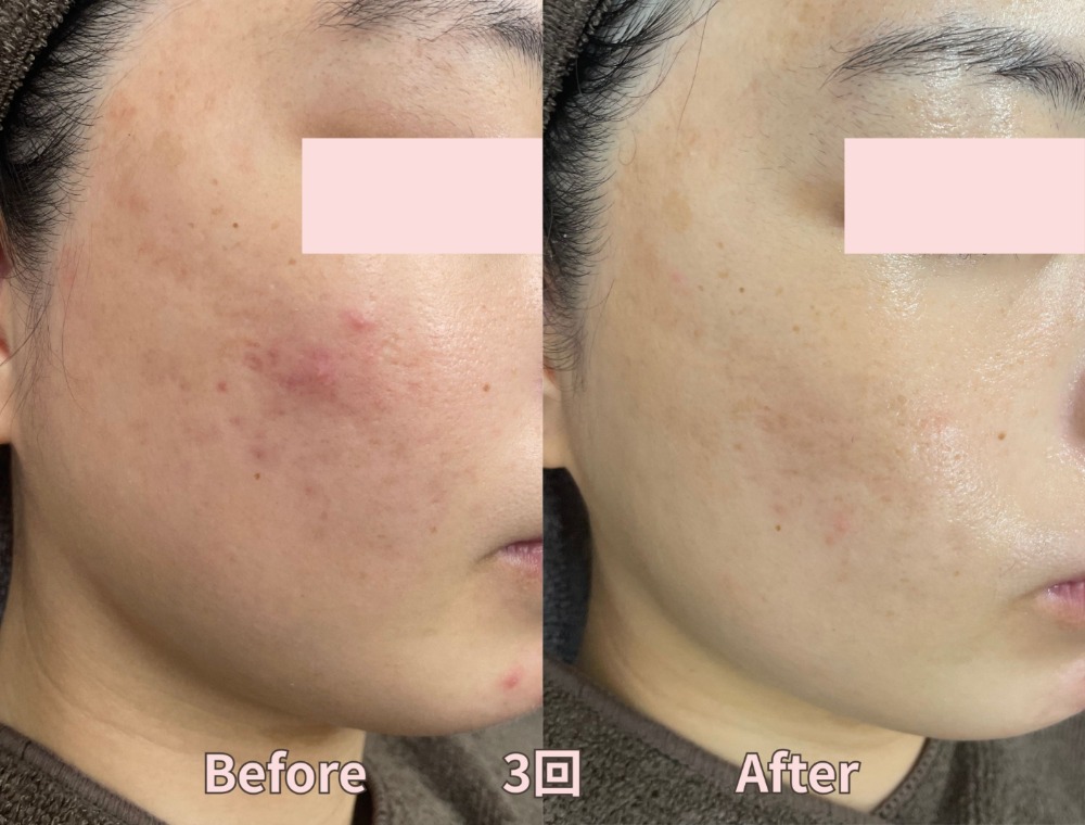 水光ピーリングで期待できる効果