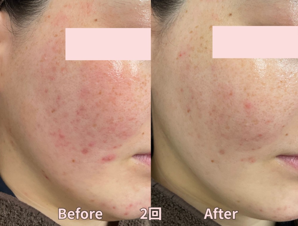 水光ピーリングで期待できる効果