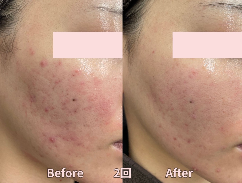 水光ピーリングで期待できる効果