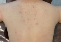 ボディーピーリング