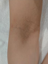 ボディーピーリング