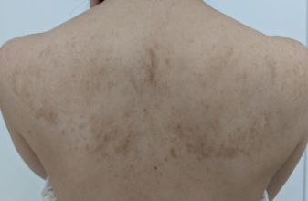 ボディーピーリング