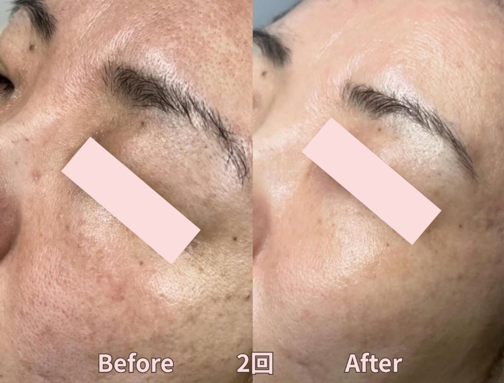 フェイシャルトリートメント