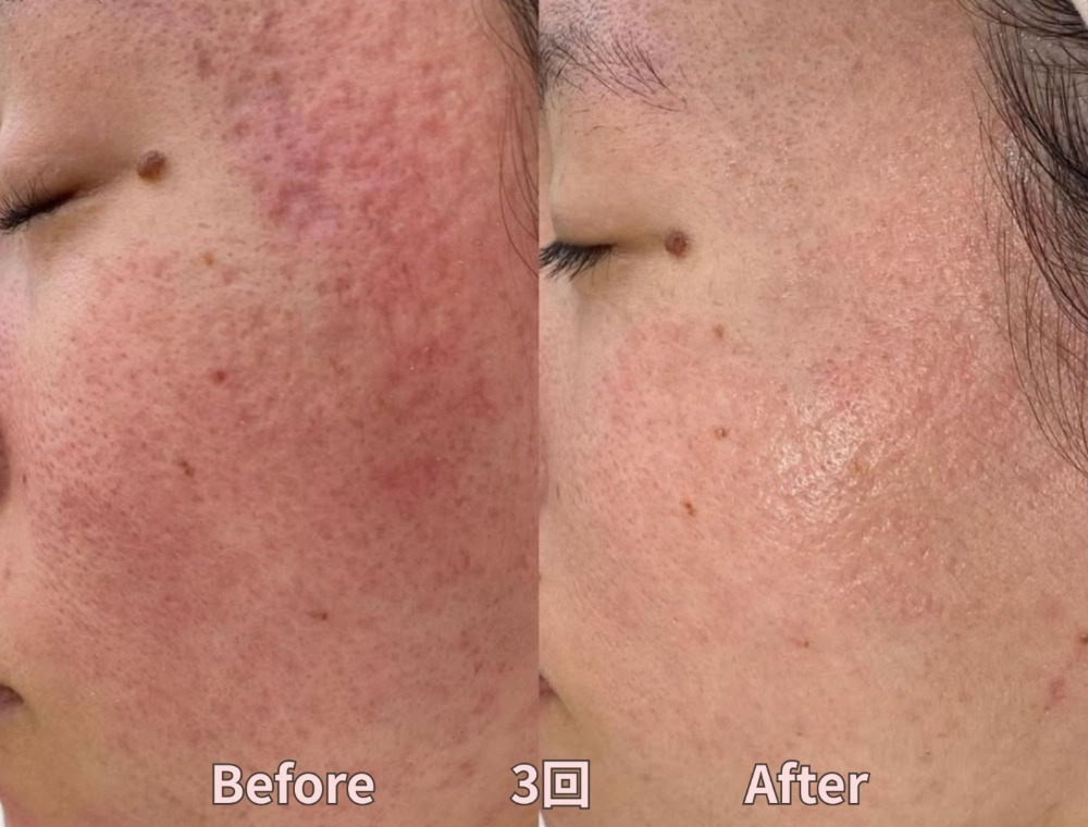 フェイシャルトリートメント