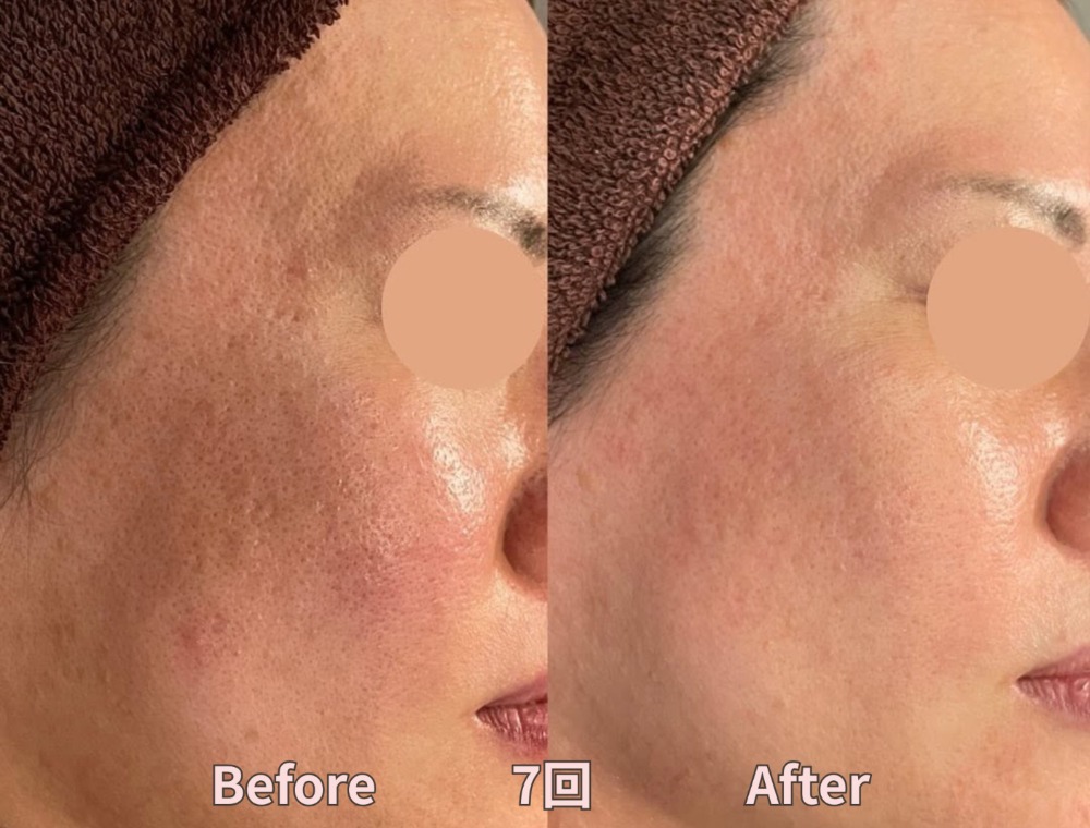 フェイシャルトリートメント