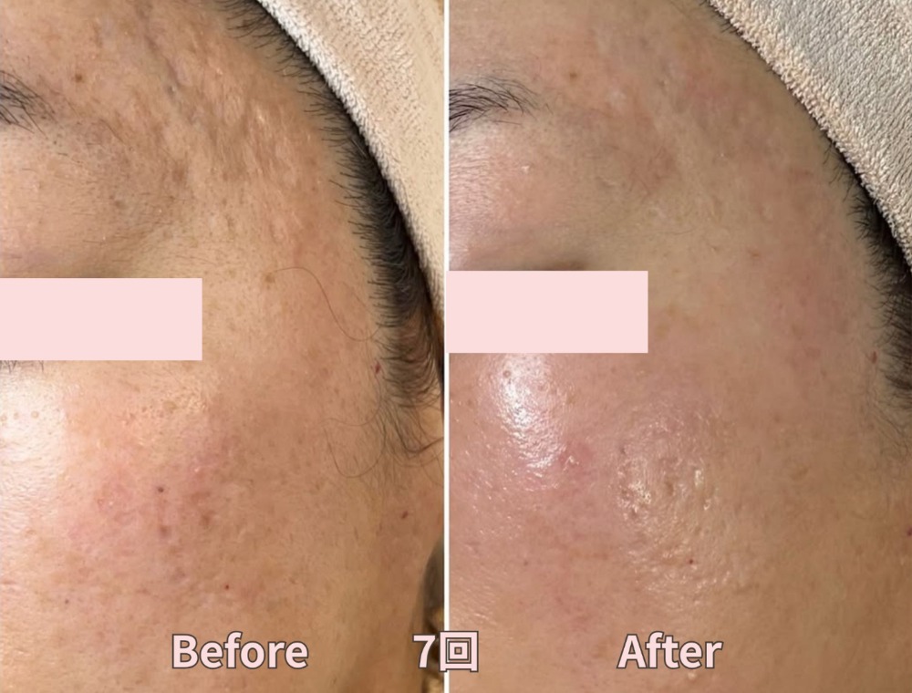 フェイシャルトリートメント