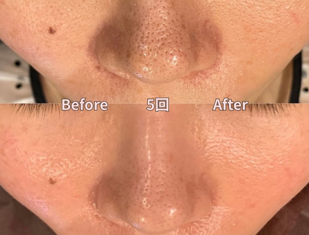 フェイシャルトリートメント