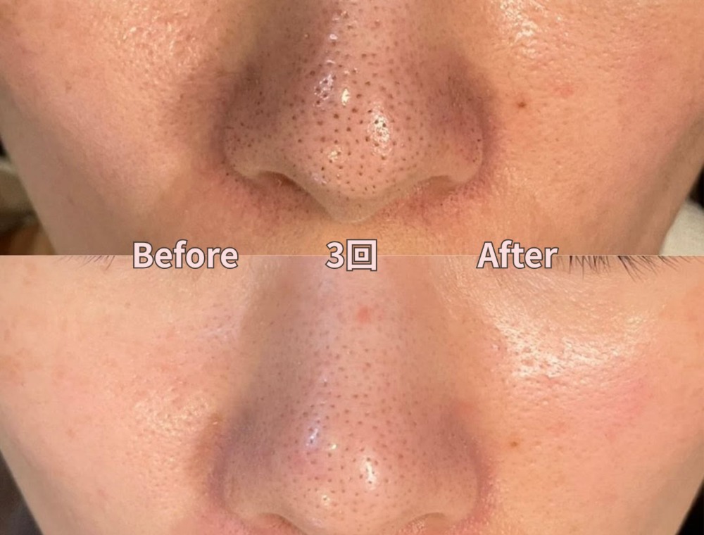 フェイシャルトリートメント