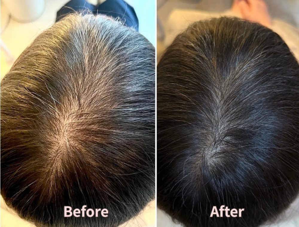 頭皮トリートメント