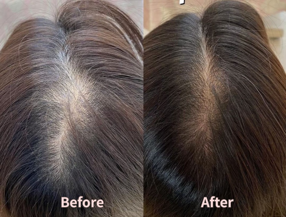 頭皮トリートメント