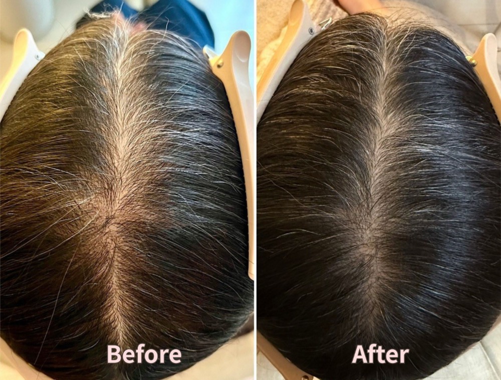 頭皮トリートメント