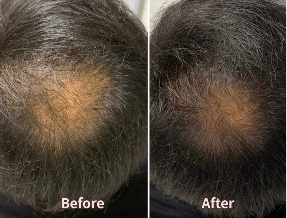 頭皮トリートメント