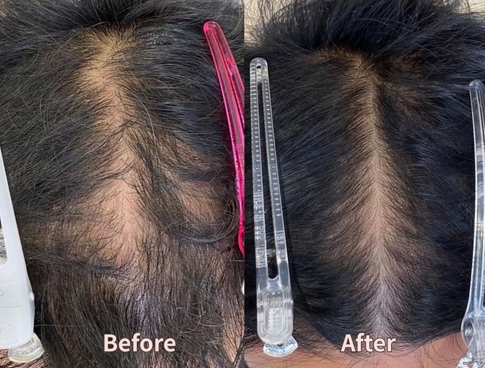 頭皮トリートメント