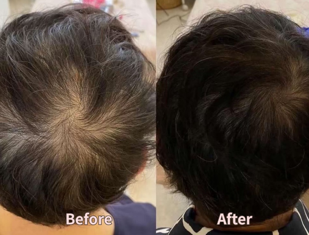 頭皮トリートメント