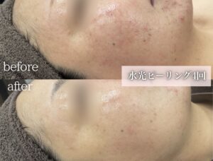 ピーリングでシミやくすみの改善へ